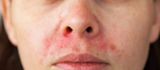 psoriasis