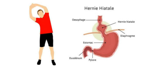 hernie hiatale