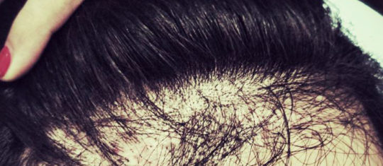microgreffes de cheveux pour femmes